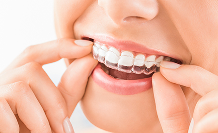 cerec crowns