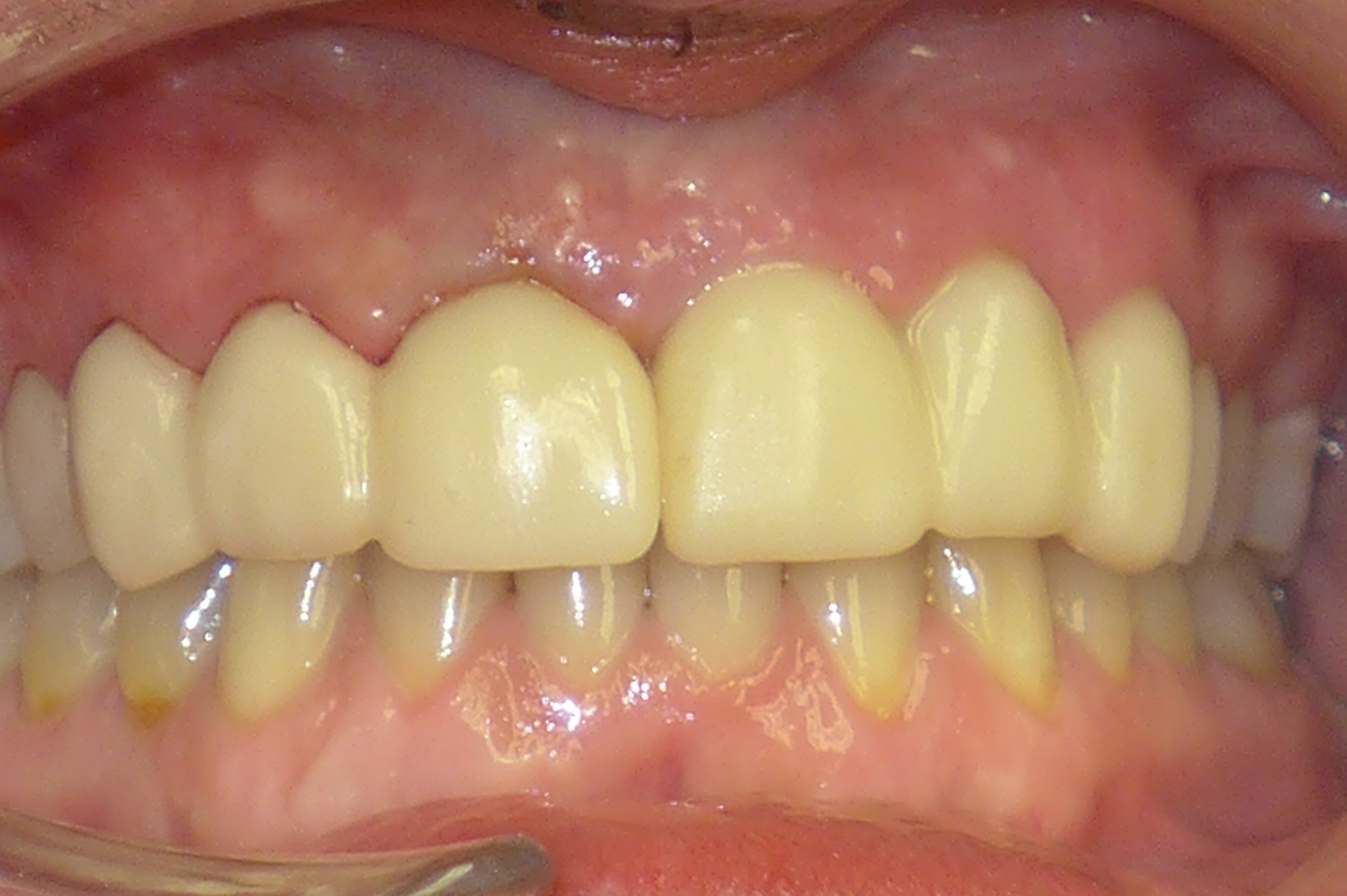 Smile Gallery - After