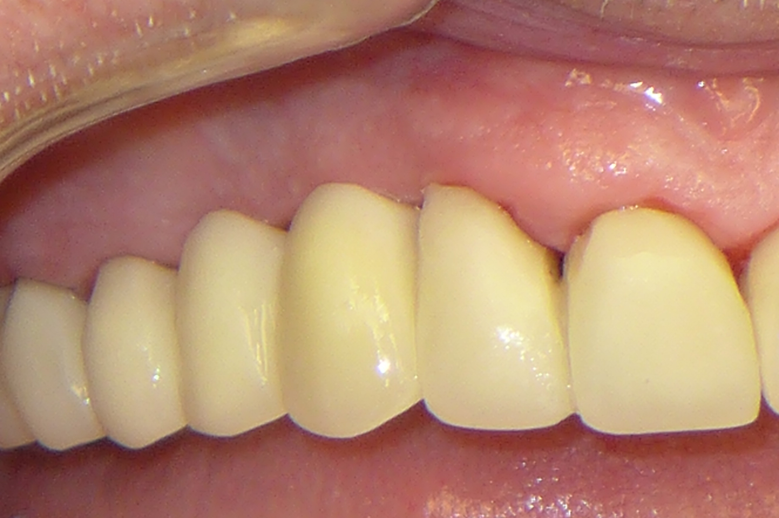 Smile Gallery - After