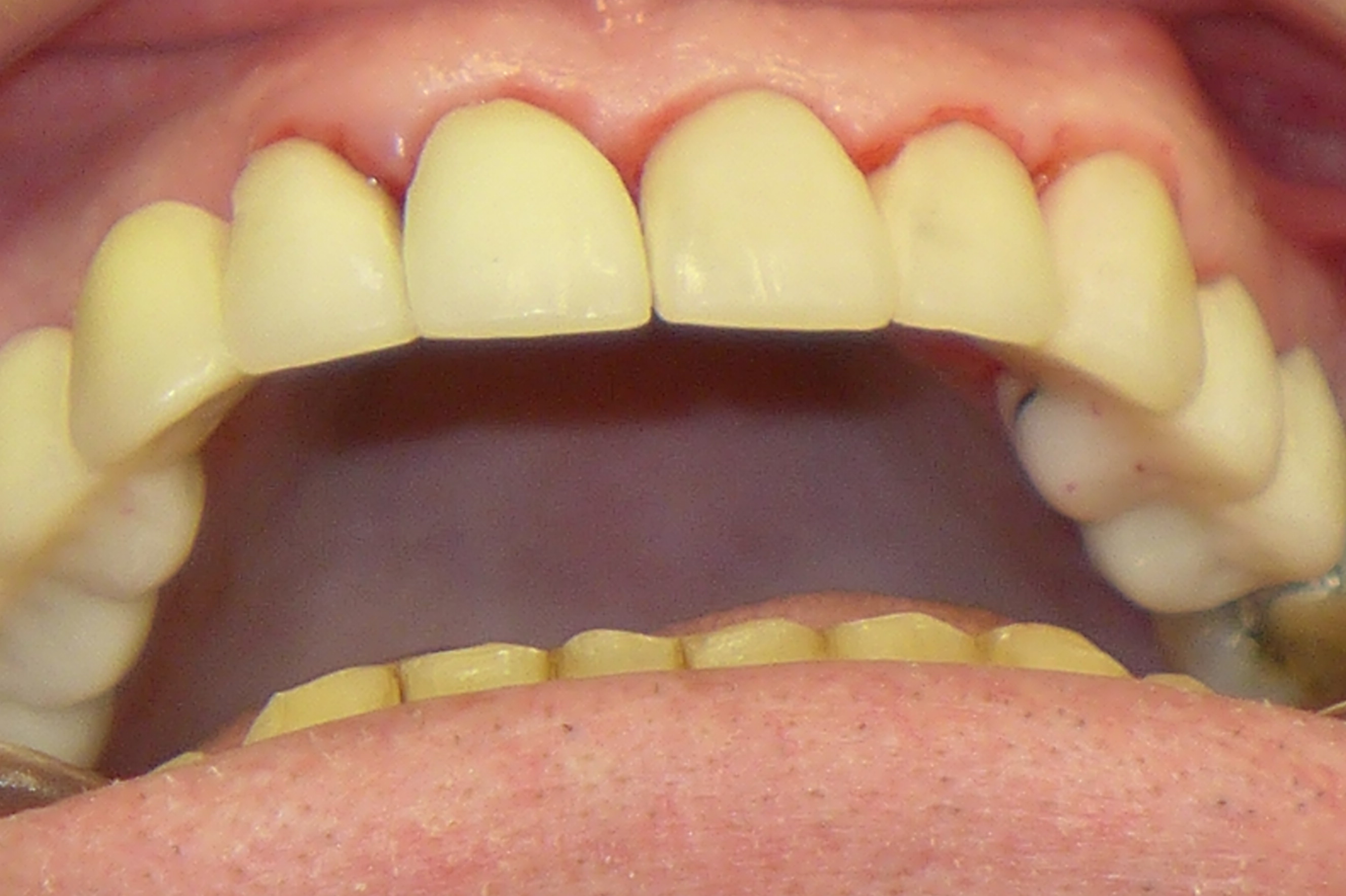 Smile Gallery - After