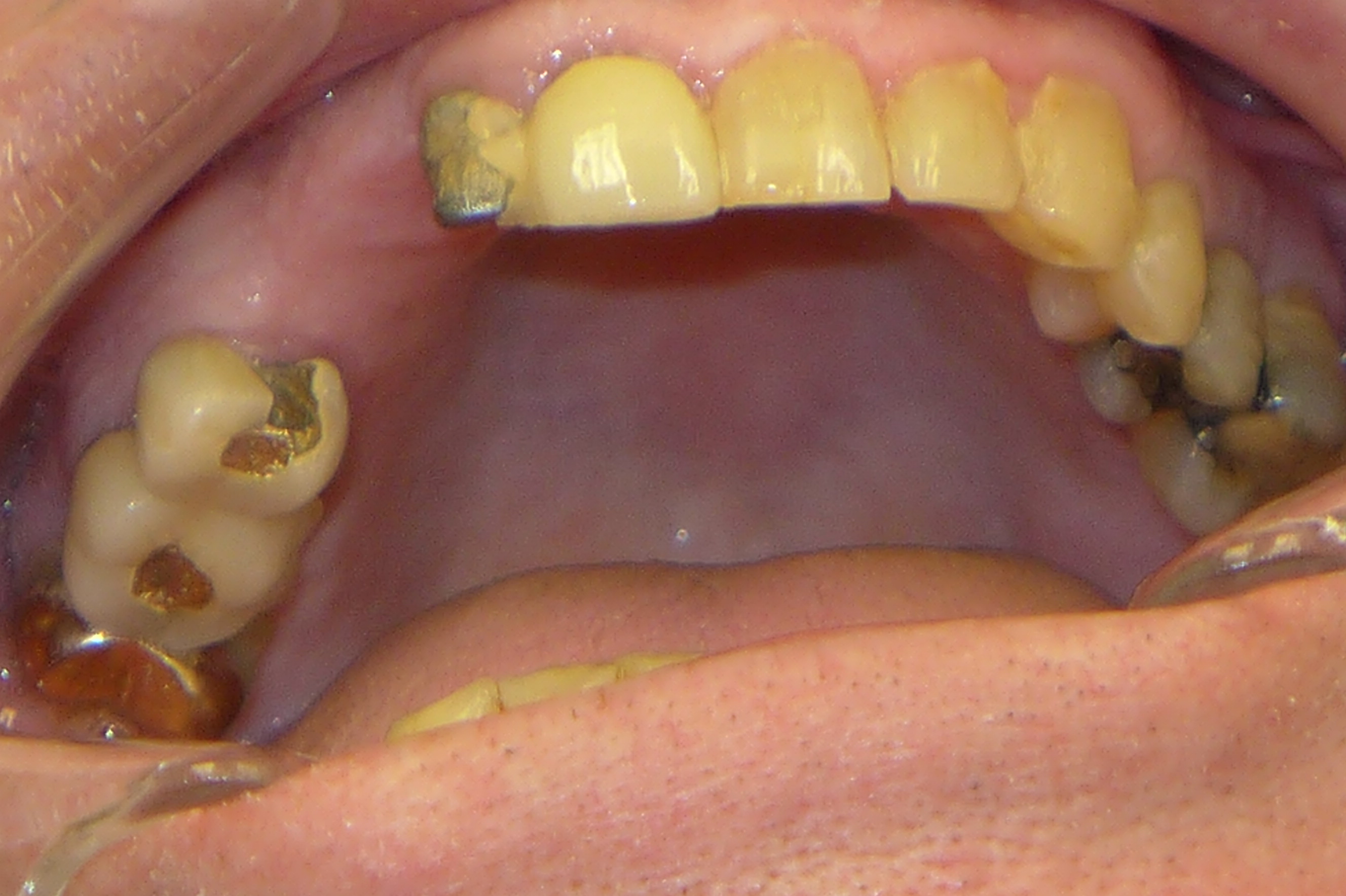 Smile Gallery - Before