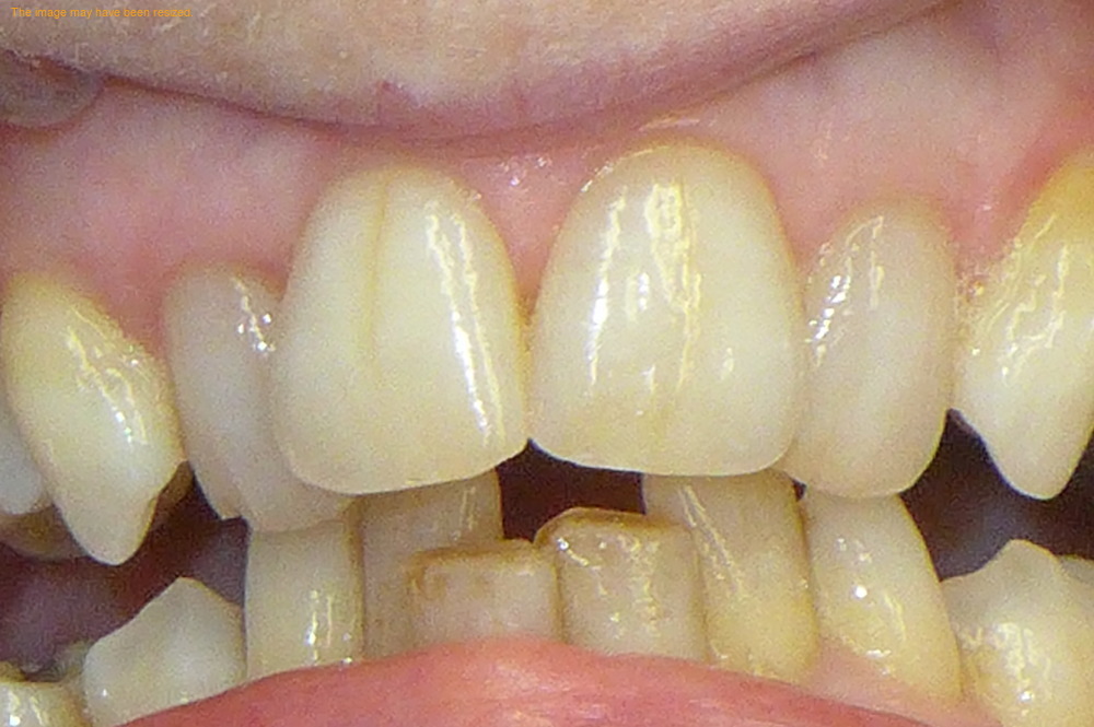 Smile Gallery - Before